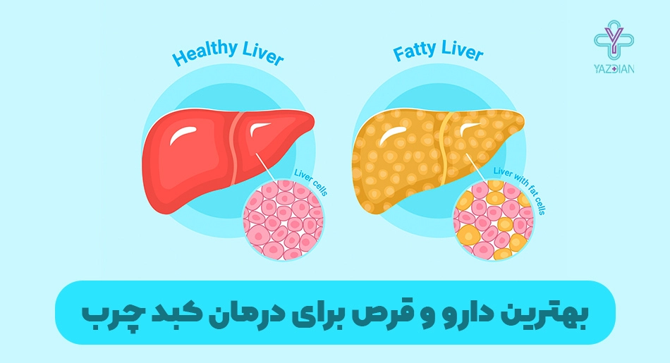 بهترین دارو و قرص برای درمان کبد چرب